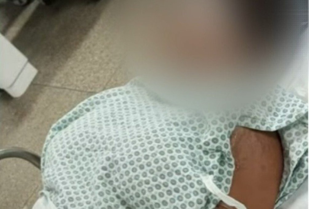 Mulher é presa em flagrante por ataque com ácido contra ex-companheira do marido; mãe da suspeita também foi detida