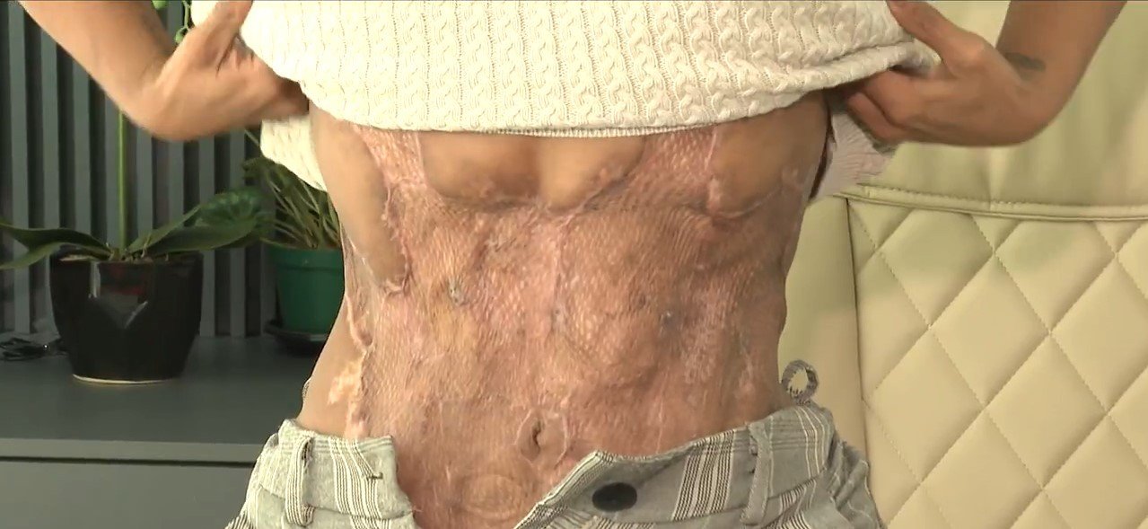 MP recebe inquérito contra médico indiciado por lesões gravíssimas em paciente durante cirurgia estética em Florianópolis
