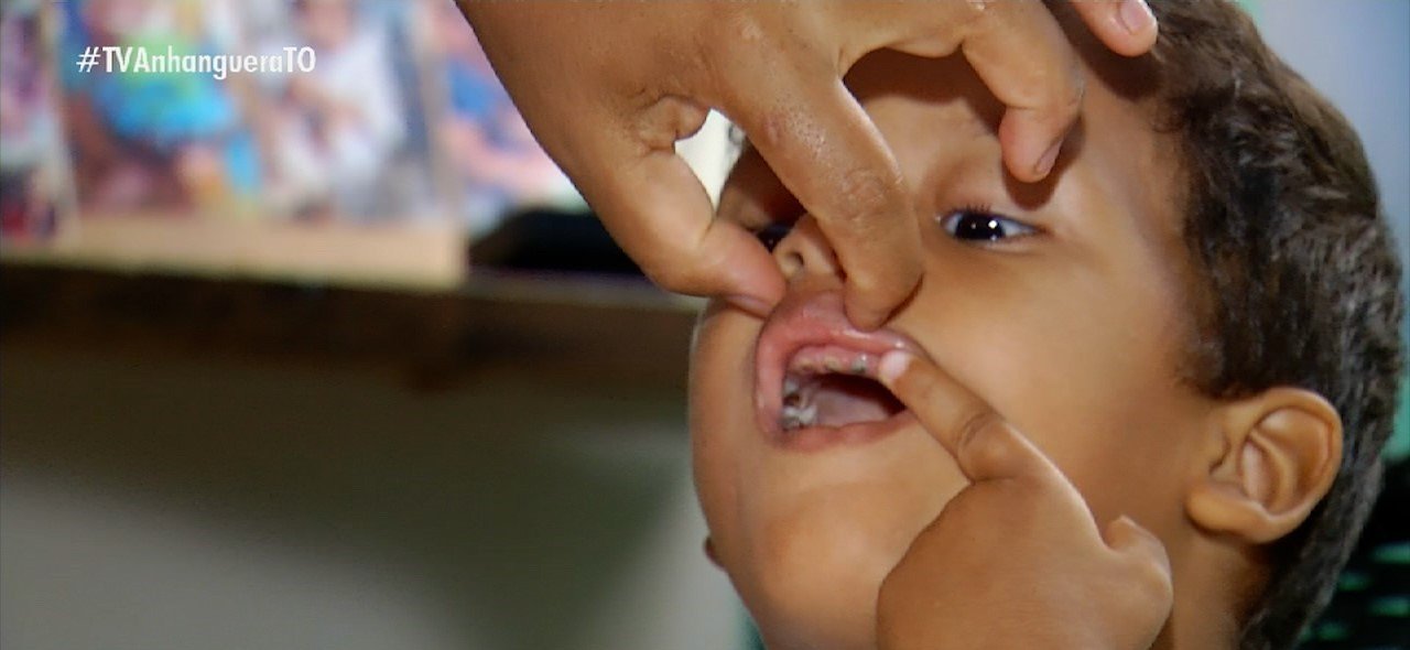 Criança de 3 anos precisa extrair todos os dentes após serem comprometidos por cáries: ‘Não consegue comer’, diz mãe