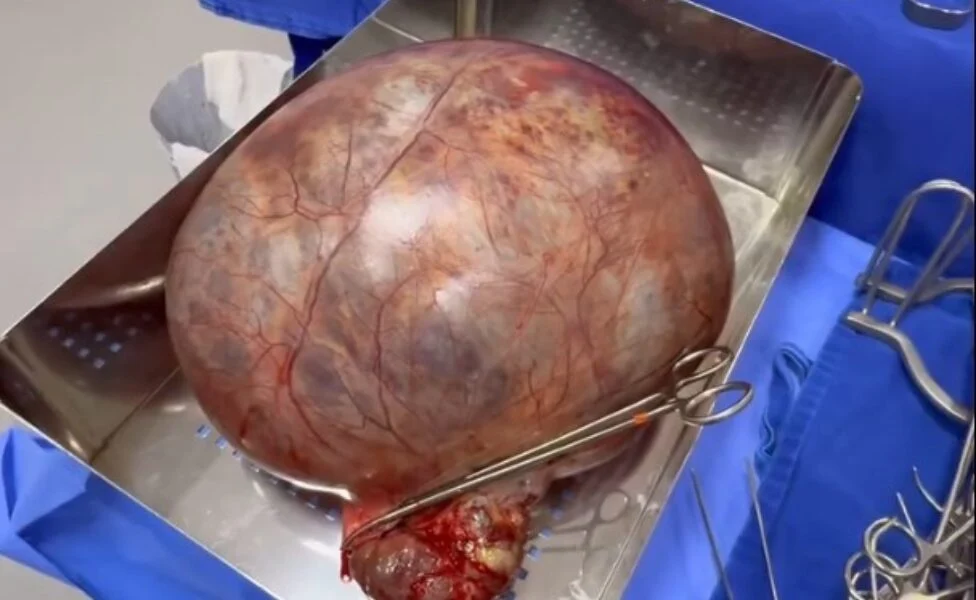 Cisto de quase 8 kg é retirado de ovário de paciente em cirurgia de urgência no Acre
