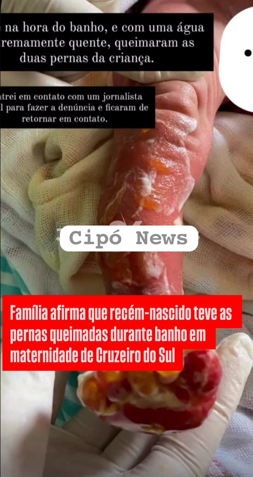 Família denuncia possível caso de negligência médica após queimaduras em recém-nascida em Cruzeiro do Sul