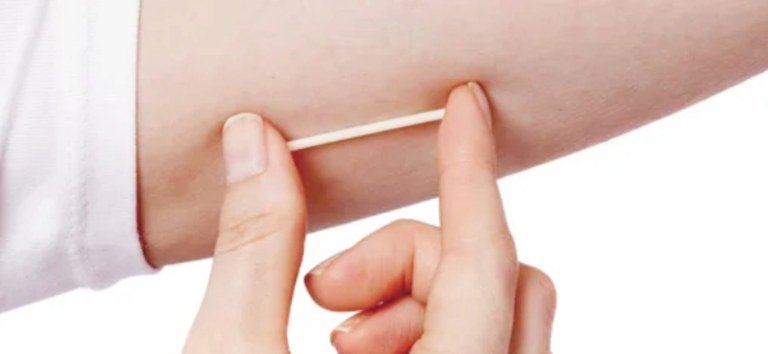 Implante contraceptivo hormonal será oferecido pelo SUS
