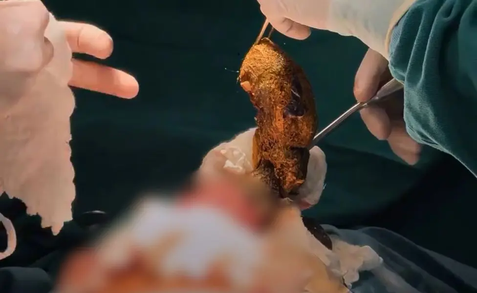 No Acre, criança faz cirurgia para retirar cabelo do estômago e intestino