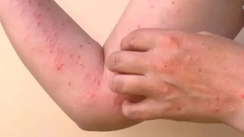 Acre registra mais de 1,2 mil notificações de chikungunya em 2025