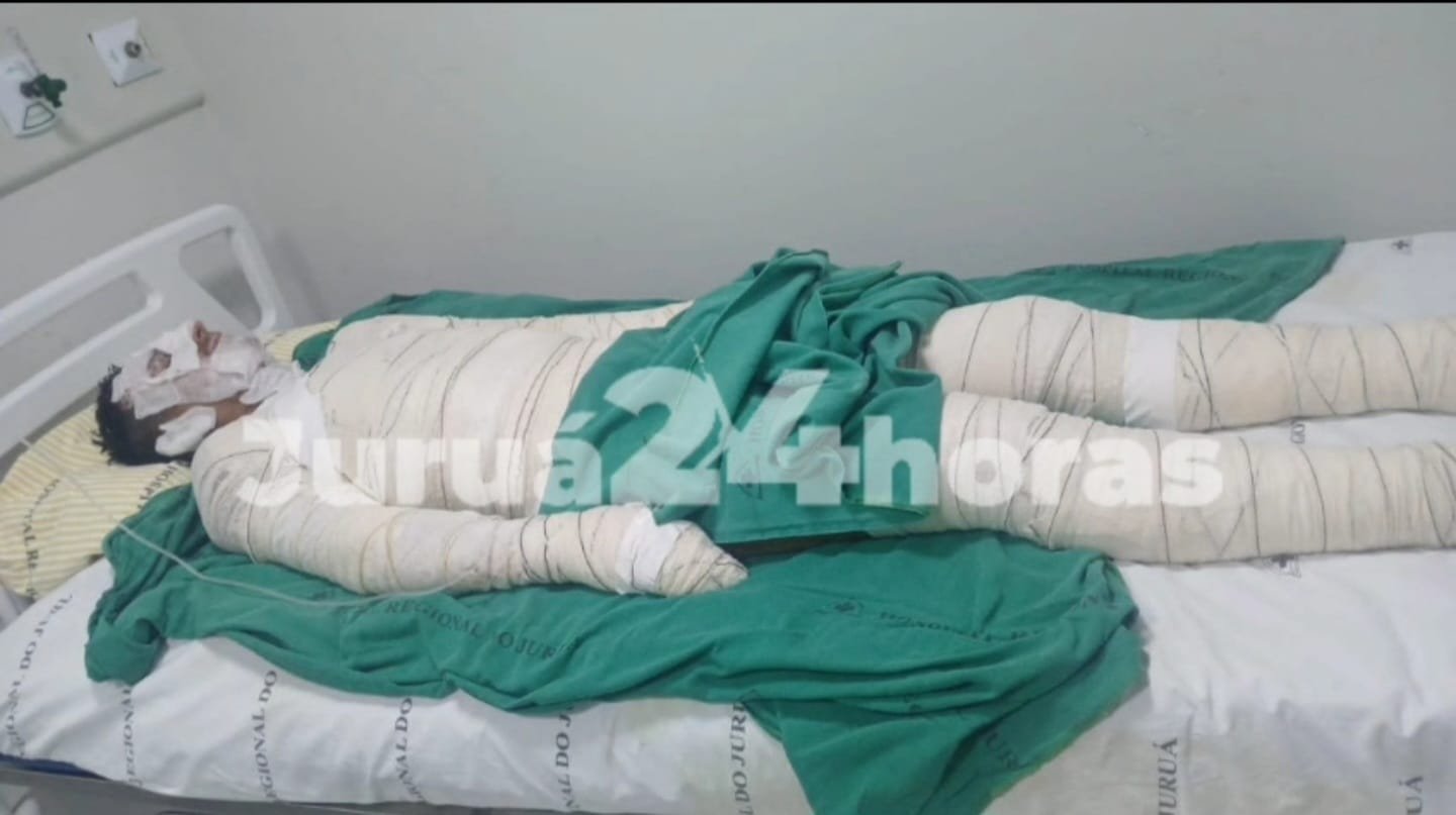 Homem sofre queimaduras graves após acidente com combustível em embarcação no Rio Juruá