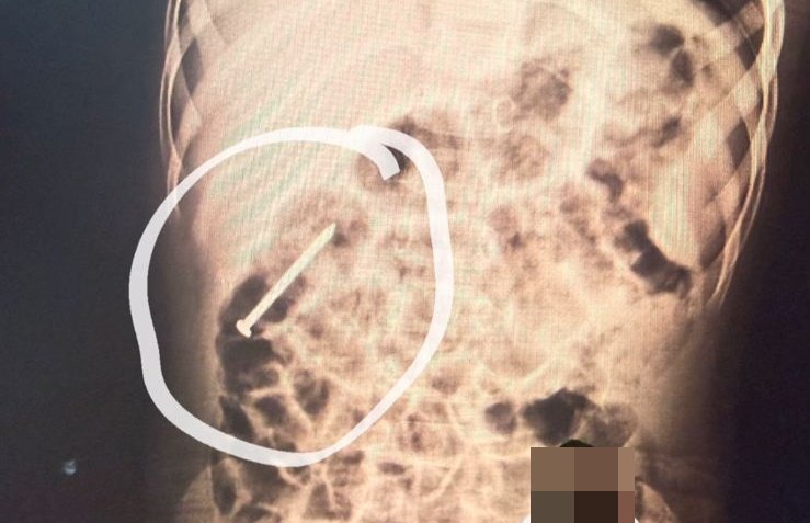 Menino de 2 anos engole prego e segue internado no Hospital do Juruá