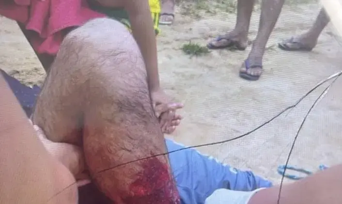 Indígena da etnia Puyanawa é ferido por disparo acidental durante caçada em Mâncio Lima