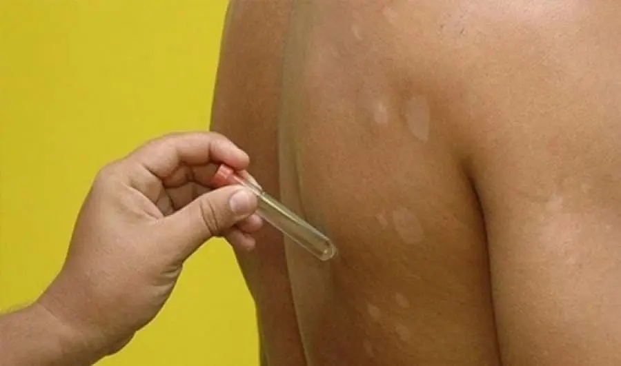 Acre ocupa 8ª posição no ranking nacional de hanseníase em 2025