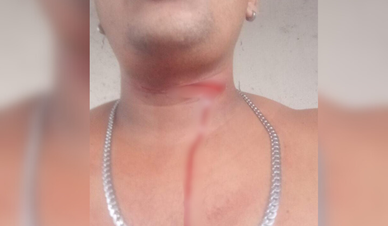 Jovem escapa da morte após ser atingido por linha de ‘papagaio’