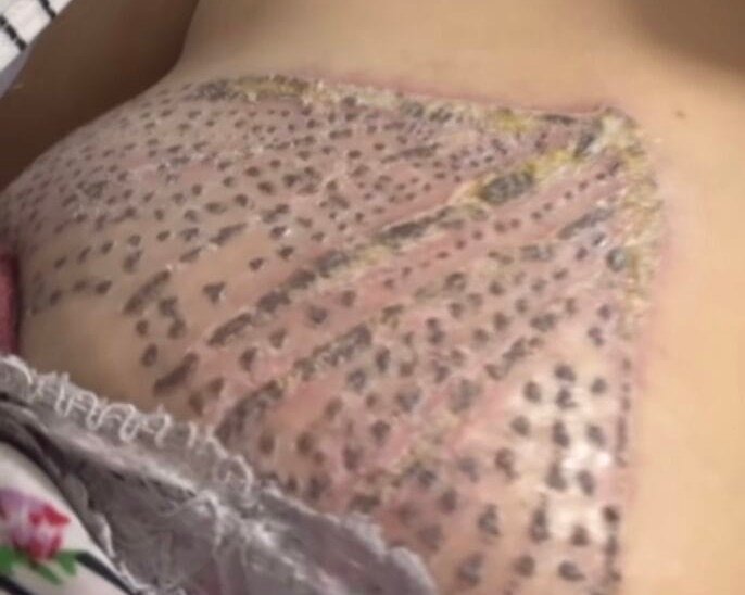 Esteticista nega erro em procedimento que causou queimaduras em Cruzeiro do Su