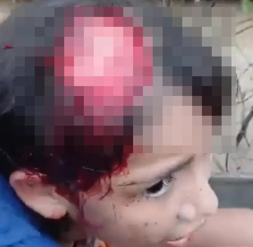 Menina de 11 anos tem parte do couro cabeludo arrancado após acidente com motor no interior do Acre