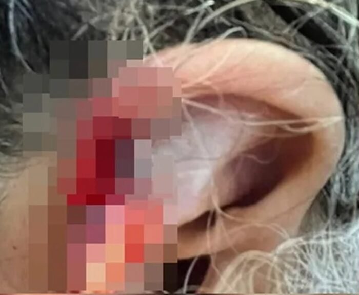 Neto arranca e engole pedaço da orelha da avó de 73 anos