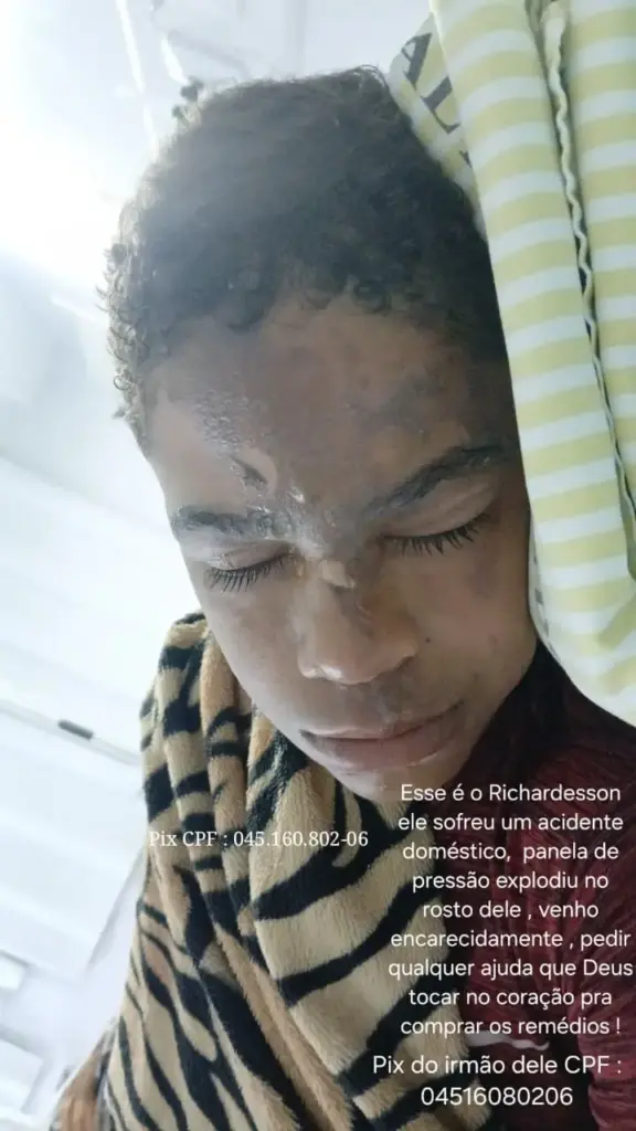 Familiares pedem ajuda para adolescente de 13 anos que sofreu graves queimaduras após explosão de panela de pressão