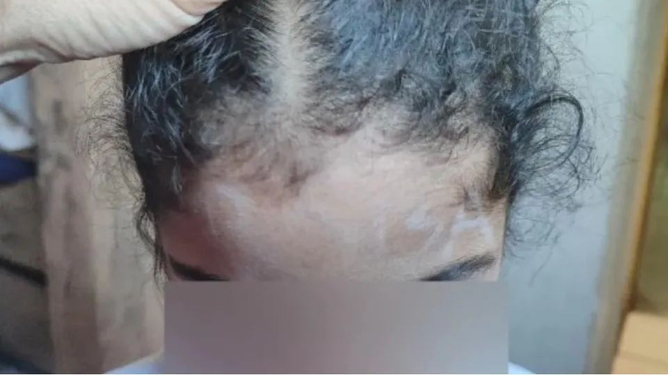 Mãe denuncia que educadora escreveu “boba” na testa da filha de 4 anos em escola