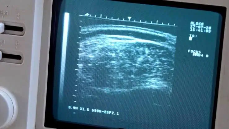 Falta de ultrassonografias deixa pacientes sem atendimento em Feijó