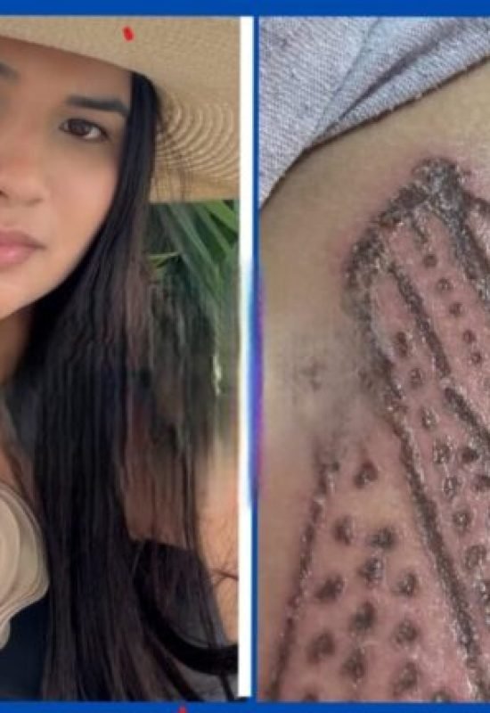 Empreendedora denuncia queimaduras após procedimento estético em Cruzeiro do Sul