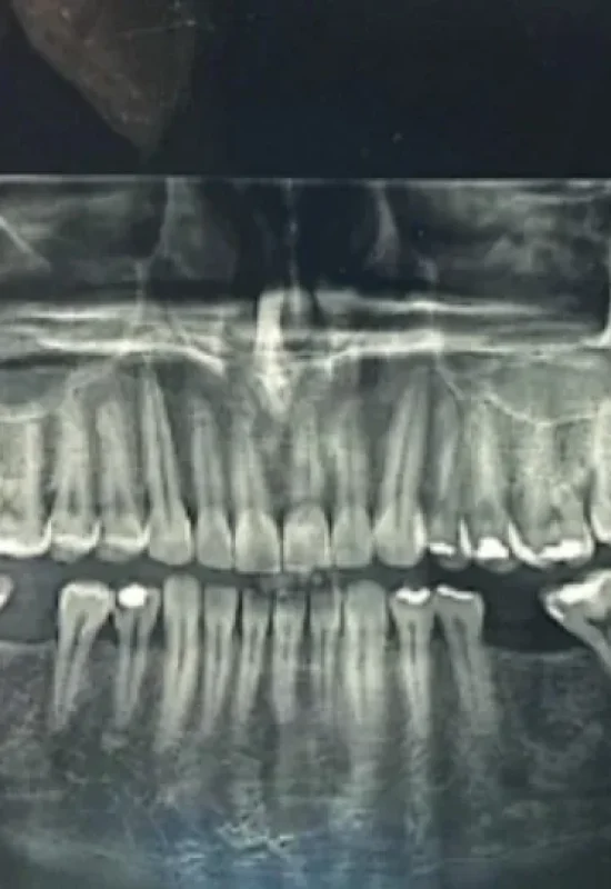 Paciente encontra agulha na boca 10 dias após extração de dente