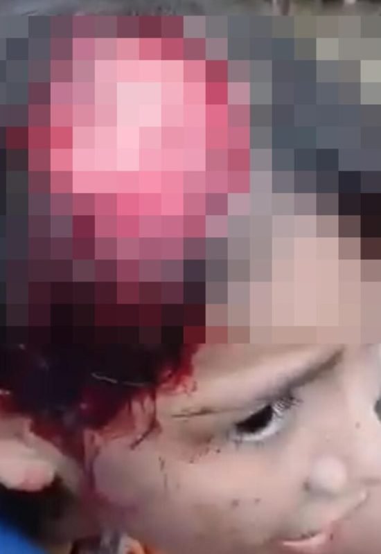 Menina de 11 anos tem parte do couro cabeludo arrancado após acidente com motor no interior do Acre