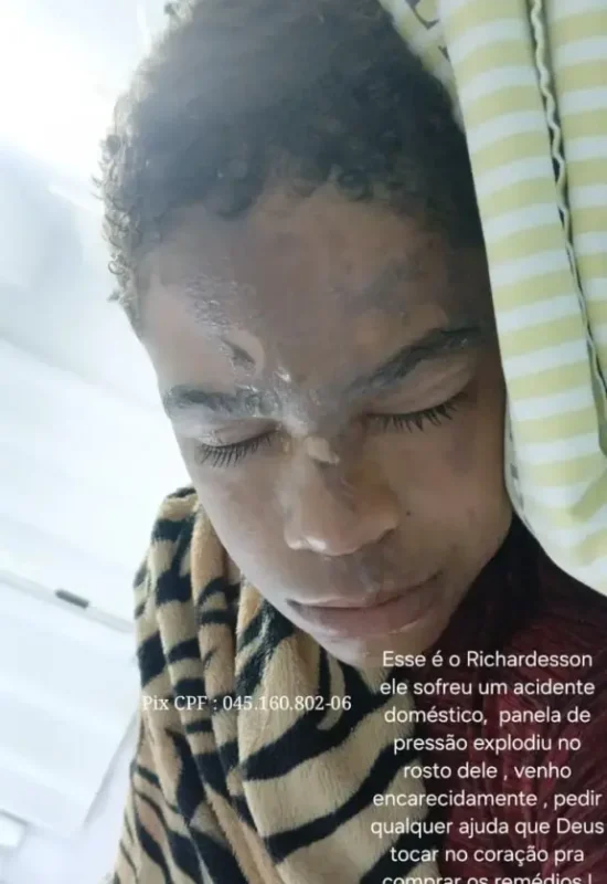 Familiares pedem ajuda para adolescente de 13 anos que sofreu graves queimaduras após explosão de panela de pressão